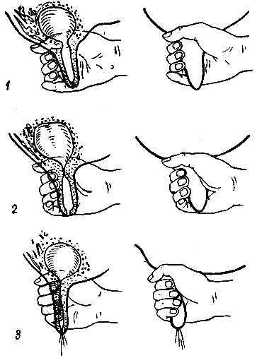 Рис. 33. Техника доения кулаком: 1 - пальцы ослаблены, молоко течет в сосок, 2 - большой и указательный пальцы перекрывают цистерну соска; 3 - пальцы постепенно сжимают сосок и выталкивают из него молоко